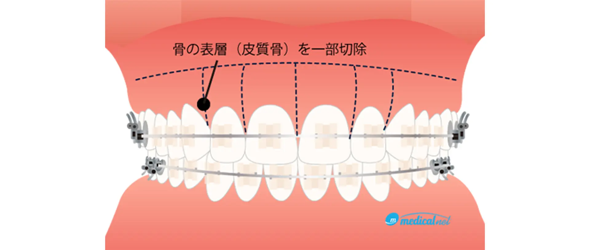 コルチコトミー(歯槽骨皮質骨切除術)とは