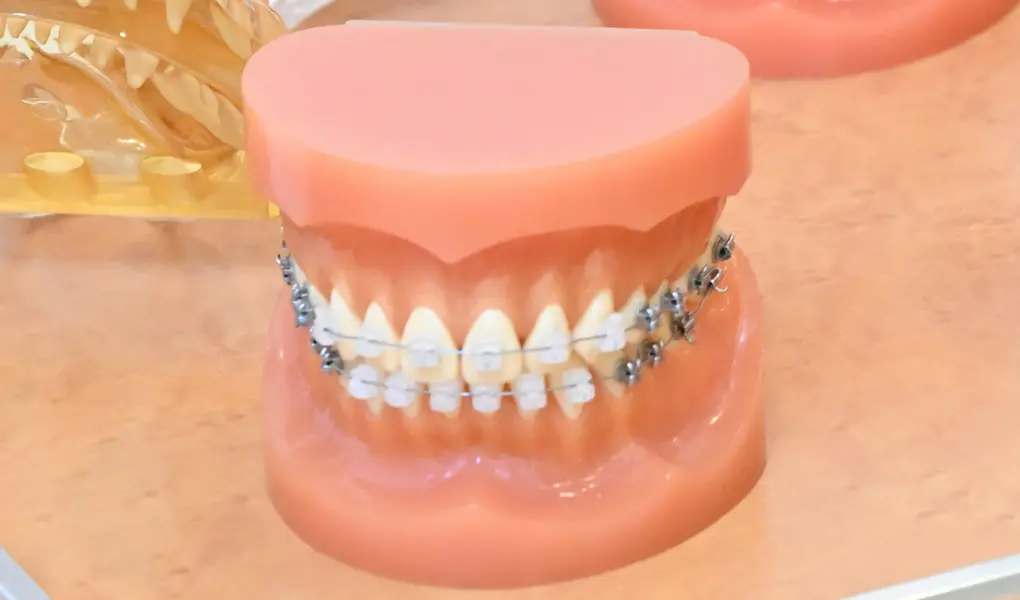 セルフライゲーションブラケット装置（デイモンシステム）