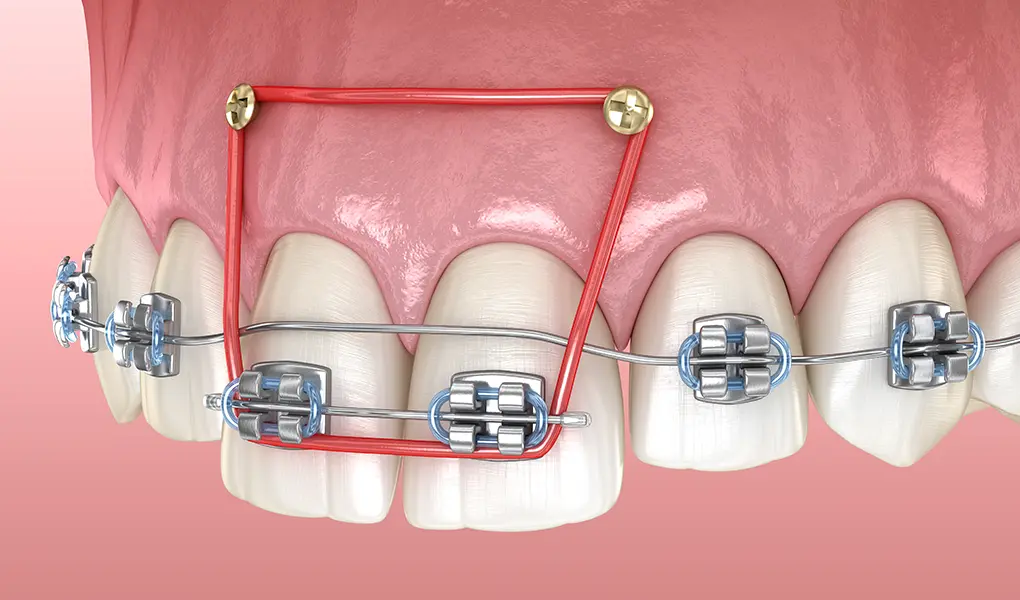 歯科矯正用アンカースクリューを用いた矯正治療