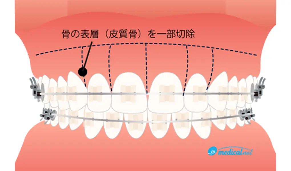 コルチコトミー（歯槽骨皮質骨切除術）
