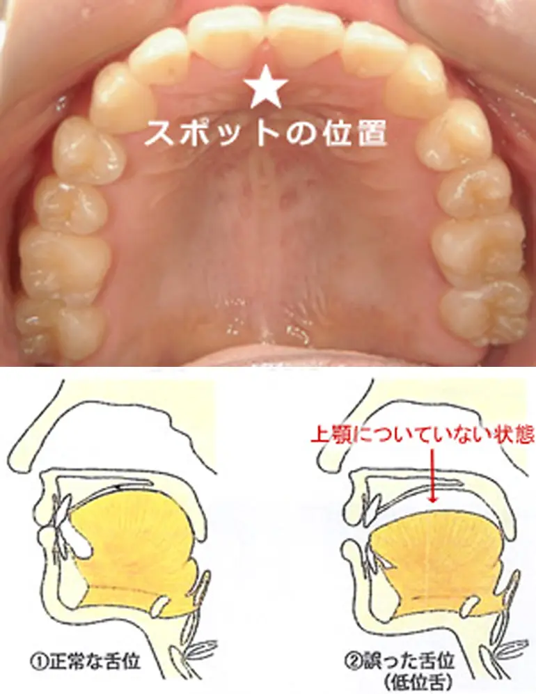 安静時の舌の正しい位置と正しい嚥下