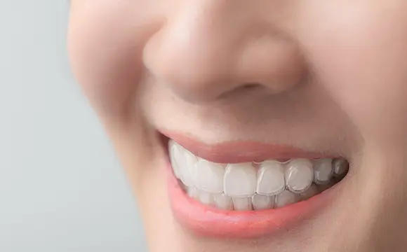 マウスピース型矯正装置（インビザライン・ライト）