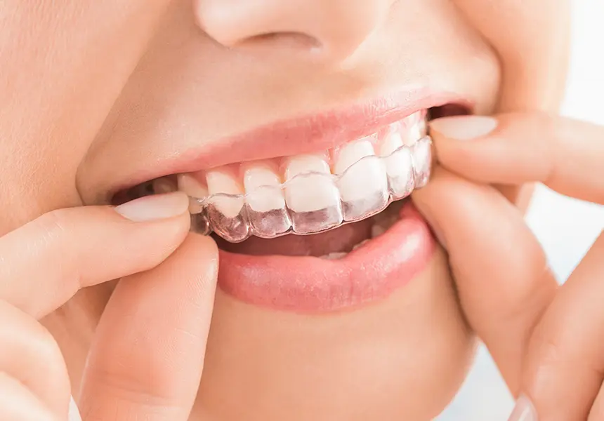 マウスピース型矯正装置（インビザライン）の治療開始（約60～90分）