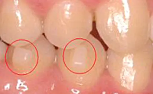 アタッチメント