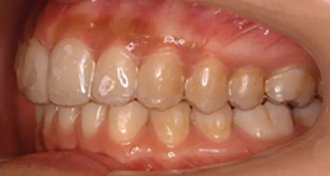 透明で歯にしっかりフィットしているため、お口をあけても装置がほとんど目立ちません。