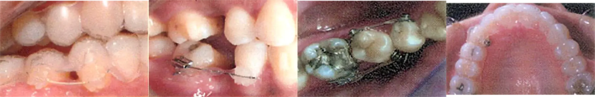 補助装置の一例とアタッチメント