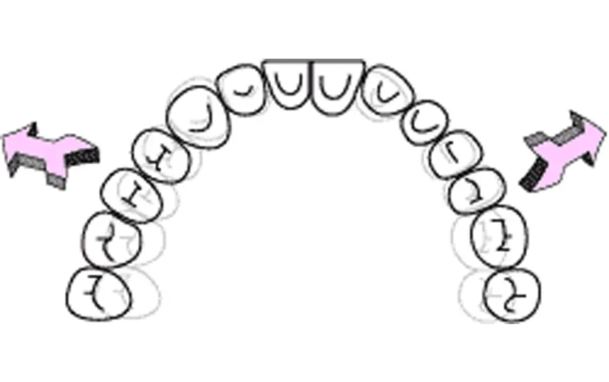 歯列自体の側方への拡大