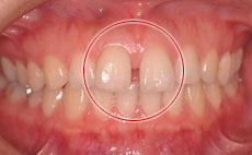 MTM（部分的な矯正）治療例3 治療前