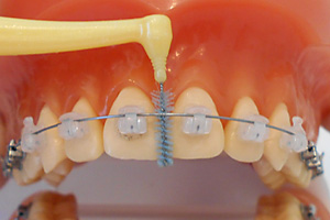 表側の装置の歯の磨き方