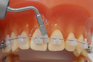 装置、装着後の院内での歯のクリーニング