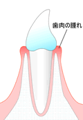 ＜初期の歯肉炎＞