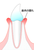 ＜慢性の歯肉炎＞
