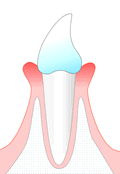 ＜初期の歯周炎＞