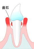 ＜中等度歯周炎＞