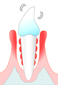 ＜重度の歯周炎＞