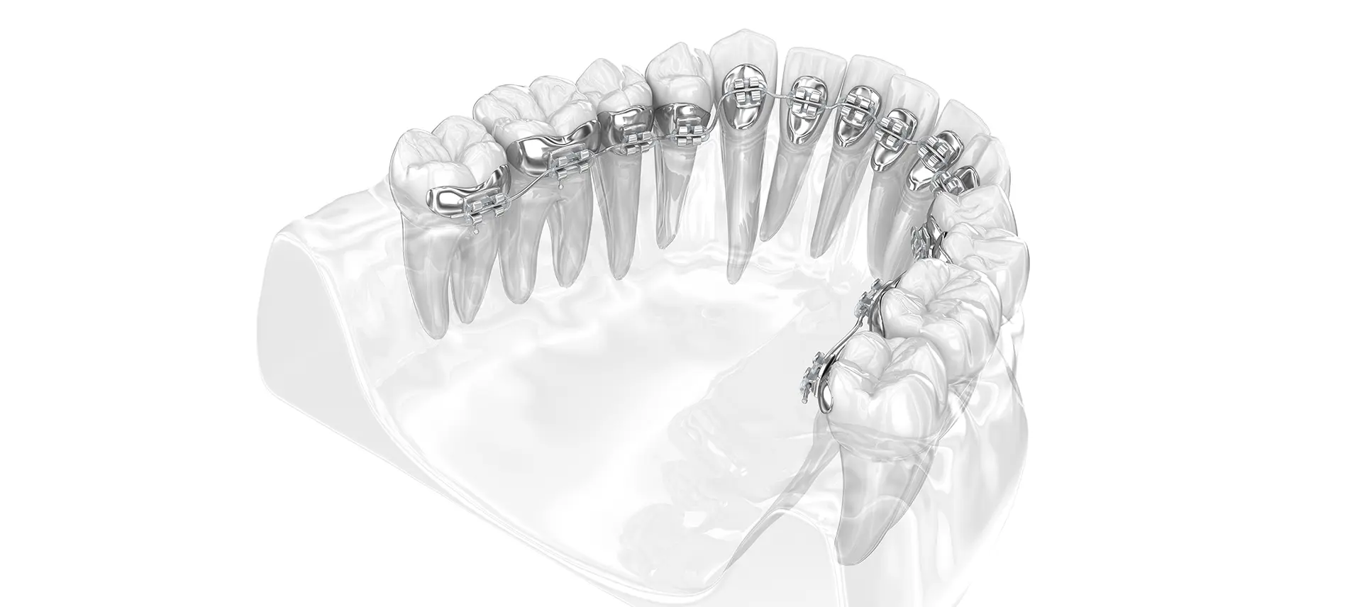 カスタムメイド型リンガルブラケット矯正装置（WIN）